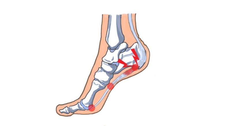 足底腱膜の痛みが出る部分